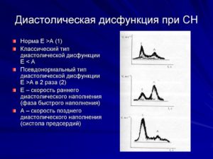 МН 1 степени, ТН 1 степени. Диастолическая дисфункция ЛЖ - 1 тип