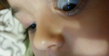 У ребенка на белках глаза серые пятна