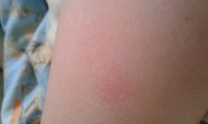 Зуд, розовые пятна, которые шелушатся