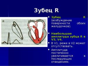 Отсутствие зубца R на V2