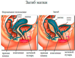 Что означает ретрофлексия матки? И смогу ли я забеременеть?