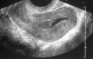 Беременность после анэмбрионии