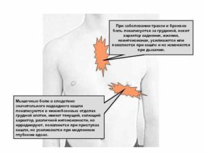 Кашель и боль под грудью слева