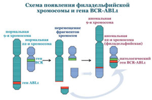 ОЛЛ с филадельфийской хромосомой