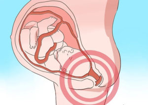 Прострелы в матке при беременности