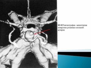 Аневризма основной артерии головного мозга