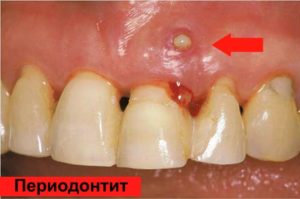 Выросла десна в дырке зуба