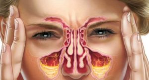 Как избавиться от запаха из носа после лечения гайморита