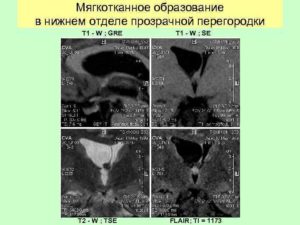 Мягкотканное образование