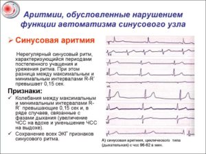 Может ли при нарушении ритма сердца, болеть голова?