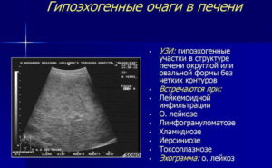 Гипоэхогенное образование печени