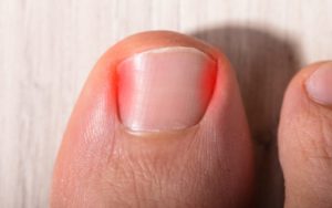 После подстригания ногтей, болит палец