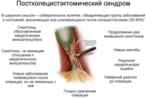 Постхолецистэктомический синдром