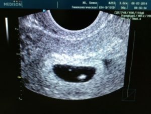 Анэмбриония и замершая беременность на ранних сроках