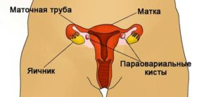 Киста на маточной трубе