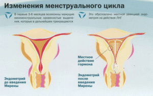 Мирена Частые и обильные месячные