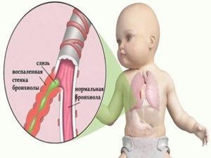 Частые Обструктивные бронхиты у ребёнка