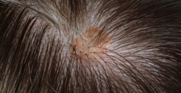 Язвочка на волосистой части головы
