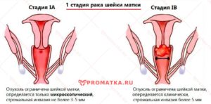 Рак шейки матки 1 А стадии