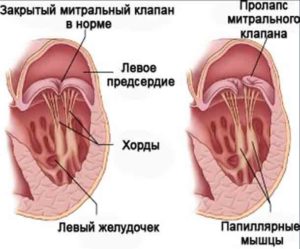 Эктопическая хорда левого желудочка