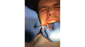 Боль под челюстью после удаления зубов