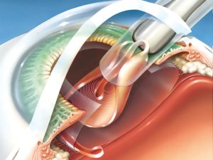 Замена искусственного хрусталика