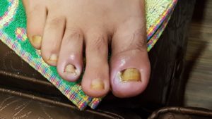 Незаживающая рана на большом пальце ноги