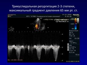 Регургитация 2-3 степени