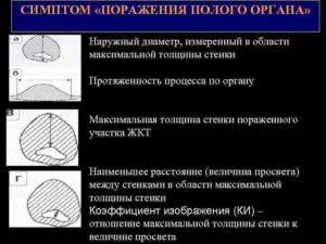 Симптом поражения полого органа