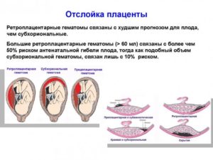 Ретрохориальная гематома и отслойка плаценты