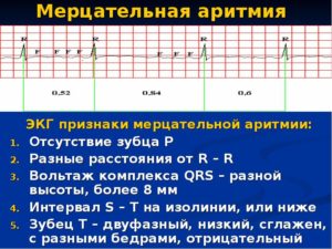 Мерцательная аритмия вагусного типа