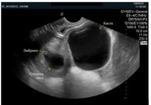 Может ли врач перепутать кисту желтого цвета с беременностью?
