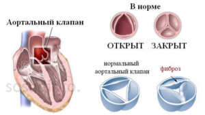 Фиброз аортального клапана