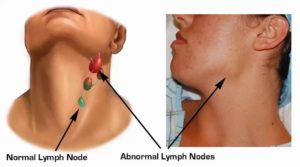 Воспален подчелюстной лимфоузел более года, боль в шее