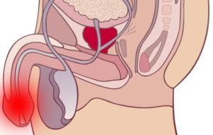 Жжение в пенисе и боль в яичках