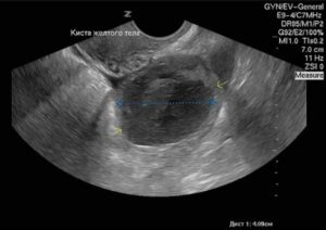 Киста жёлтого тела или беременность