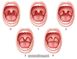 Увеличена миндалина с правой стороны