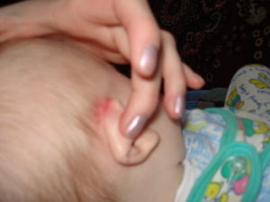 Мокнущие кроваточащие раны за ушами у ребенка 4,5 лет