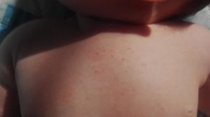 Сыпь чуть ниже груди у ребенка 12 лет