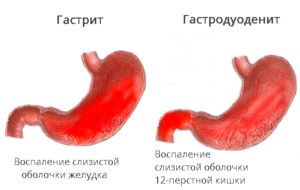 Не могу вылечить гастродуоденит и скр