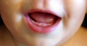 Первые молочные зубы лезут криво