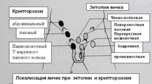 Крипторхизм, мошонка, яички, гормоны