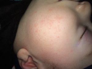 Сыпь у 2-х месячного ребёнка