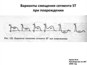 Смещение сегмента ST