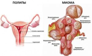 Полип эндометрия и миома