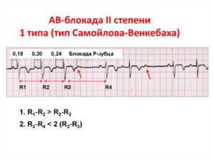 СССУ, БЛОКАДА самойлова венкебаха