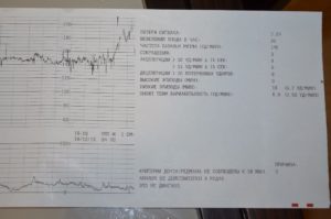 Беременность 33-34 недели, уменьшение шевелений плода