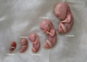 Аборт на 11 неделе