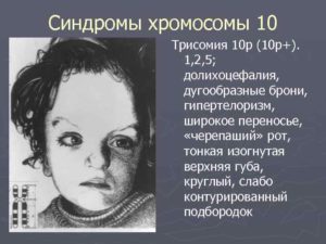 Трисомия 10 хромосомы