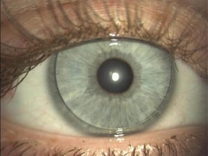 Дискомфорт от линзы на левом глазу